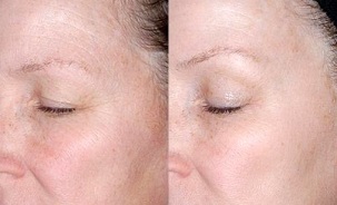 rejuvenecimiento de la piel alrededor de los ojos fotos antes y después