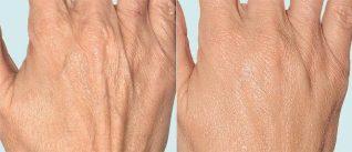 Piel de las manos antes y después de la terapia fraccionada